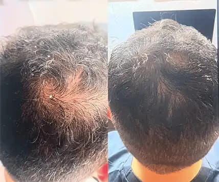 Antes e depois alopecia androgenética masculina Salvador — medicina capilar Dra. Isabelle Ledo