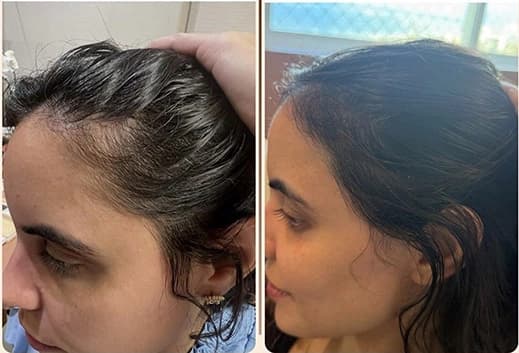Resultado tratamento eflúvio telógeno feminino — Dra. Isabelle Ledo tricologista Salvador-BA